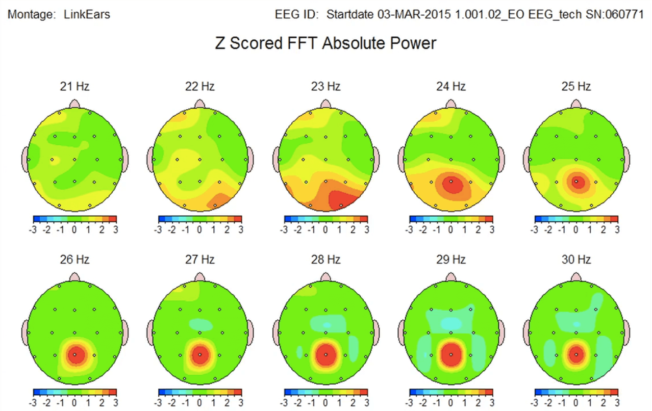 EEG brain scan before Access Bars session